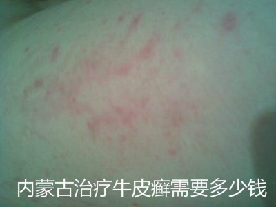 牛皮癣早期治疗，理解、重视与行动的重要性